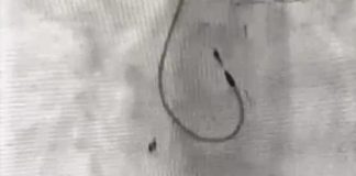 За забытый в теле ребёнка катетер с новосибирских врачей требуют миллионы