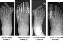 Новосибирские хирурги пересобрали женщине деформированные стопы